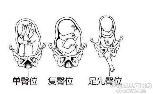 胎儿臀位是什么意思 胎儿臀位是什么原因造成的